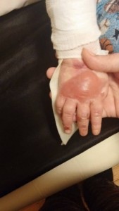 blister on Jax's hand