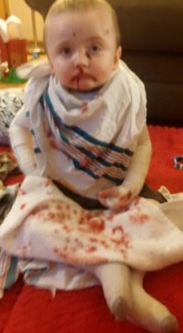 Jax suffering from a severe nose bleed